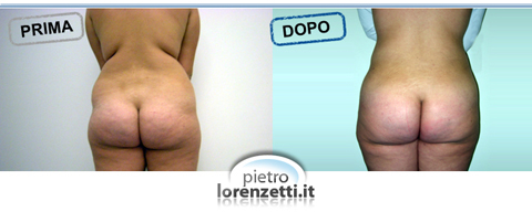 Liposculture prima-dopo