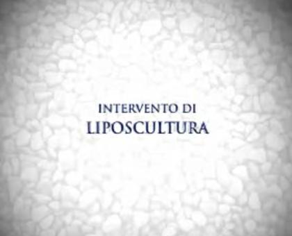 Liposcultura