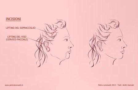 01. gennaio, lifting viso piccola