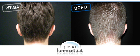 Otoplastica prima-dopo
