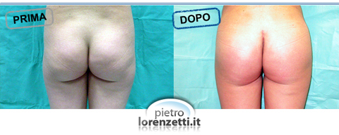Gluteoplastica prima-dopo