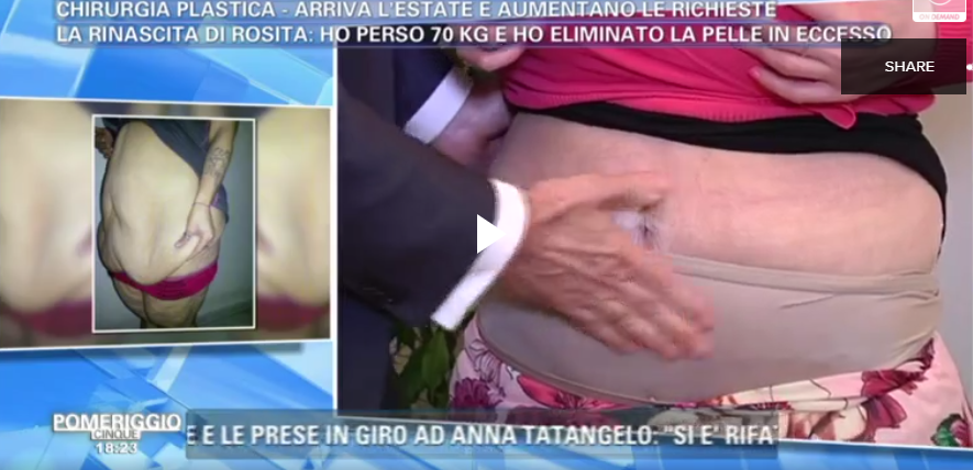 risultati_lifting_circonferenziale
