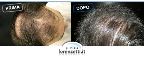 Trapianto capelli prima-dopo