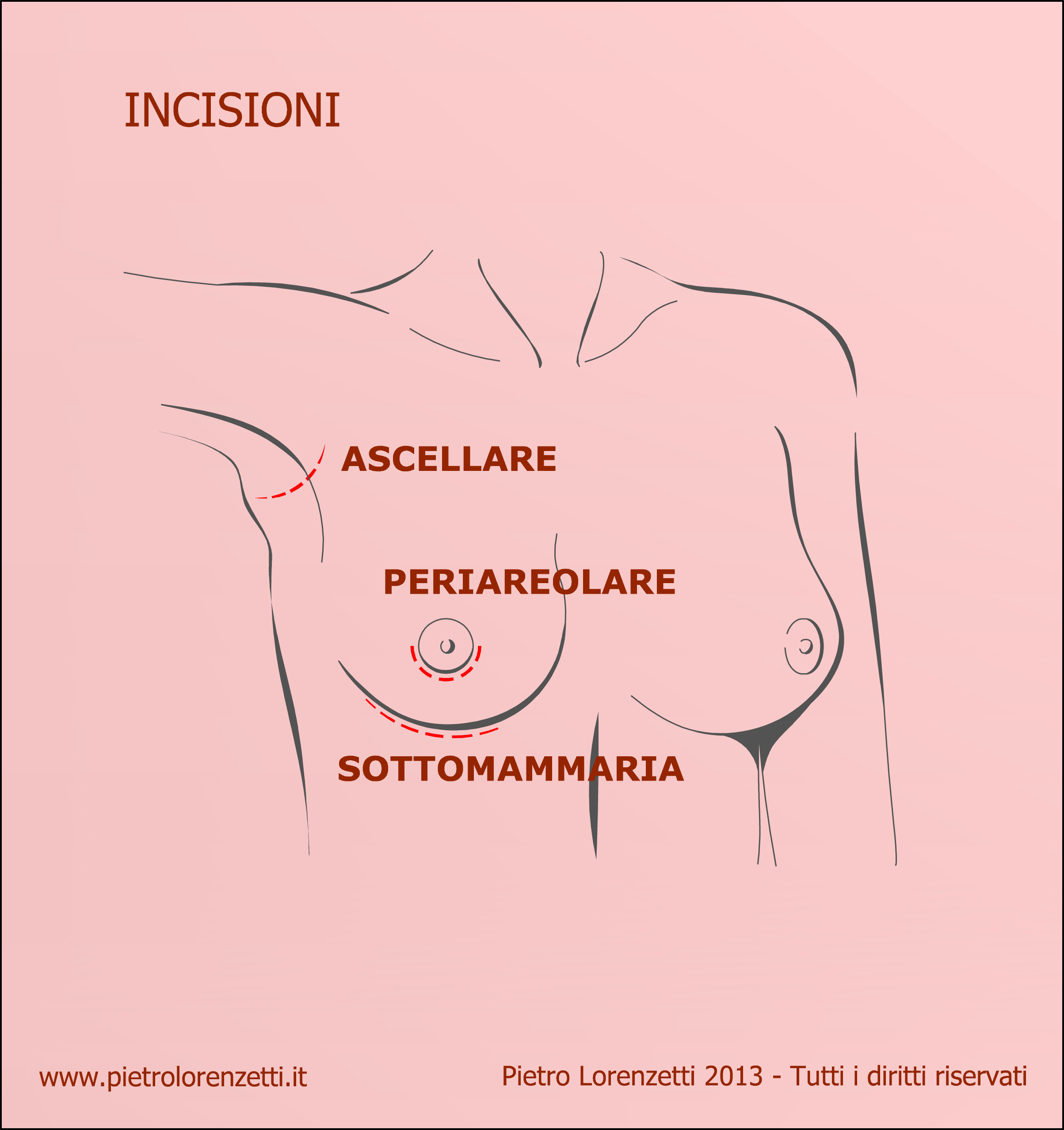 Incisioni mastoplastica additiva